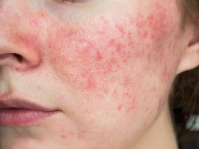 NRS Rosacea  © Yuliya Shauerman Getty Images