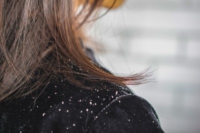 Dandruff © Doucefleur Getty Images